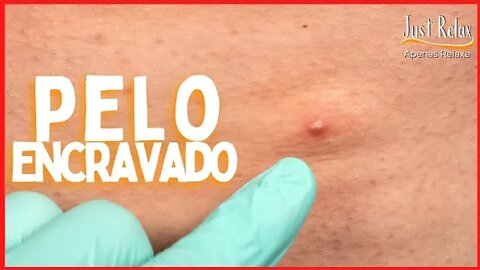 Relaxante e Satisfatório Remoção de Pelo Encravado Foliculite - Just Relax | Apenas Relaxe