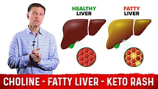 Choline: One of The Best Vitamins for Fatty Liver – Dr. Berg