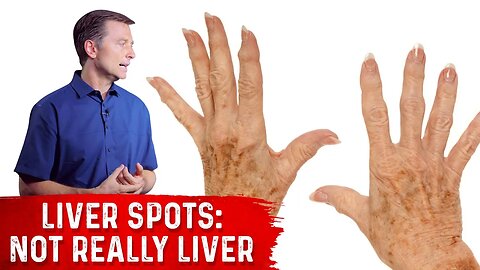 What Causes Liver Spots (Age Spots)? – Dr. Berg on Vitamin C Deficiency