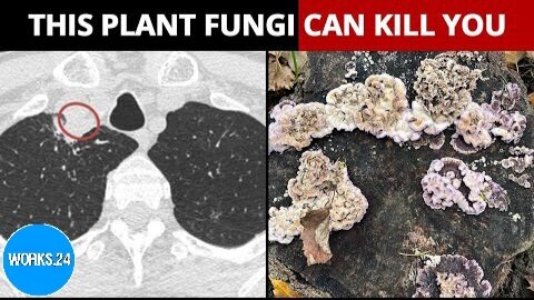 This Human Is The First Man In The World To Be Infected By Rare Killer Plant Fungus | NewsMo