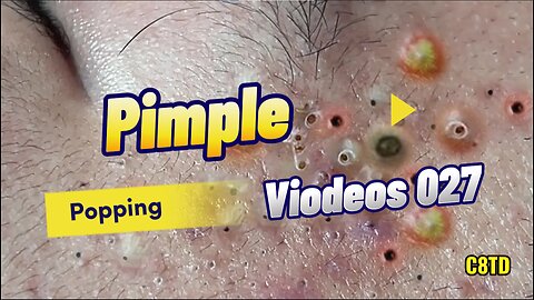 Satisfying Pimple Popping Videos 027