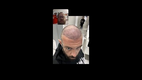 Adam22 Gets Hair Transplant In Turkey