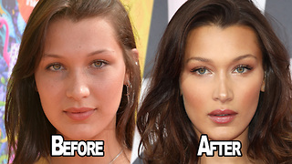 Bella Hadid OPENS UP About Having Plastic Surgery!