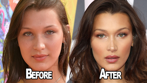 Bella Hadid OPENS UP About Having Plastic Surgery!