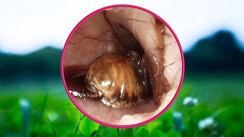 BugBeetle In Human Ear Removal - Dead Insect - Endoscopic Removal