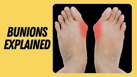 What are bunions? | Foot Bunion explained