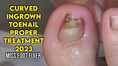 CURVED INGROWN TOENAIL PROPER TREATMENT BY FAMOUS PODIATRIST MISS FOOT FIXER 2023