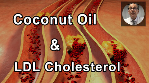 Low Or No Coconut Oil Will Be The Best For Your LDL Cholesterol - Joel Kahn, MD