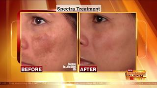 Get Radiant Skin with a Hollywood Laser Peel