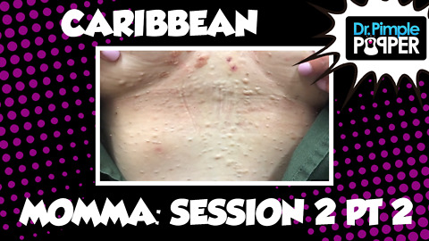 Caribbean Momma Steatocystomas: Session Two, Part Two