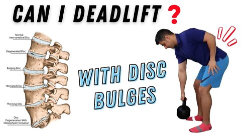 How to do deadlift with lumbar spine disc Bulges