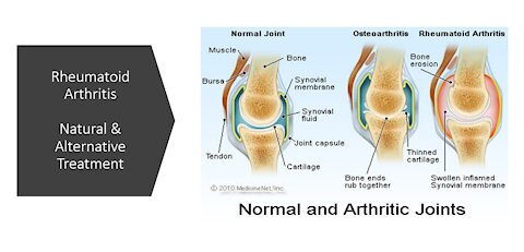 Rheumatoid Arthritis - Natural and Alternative Treatment