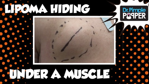 Lipoma Hiding Under A Muscle!