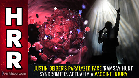 Justin Beiber's PARALYZED face 'Ramsay Hunt Syndrome' is actually a VACCINE INJURY
