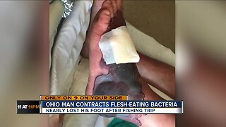 Waynesville man contracts flesh eating bacteria