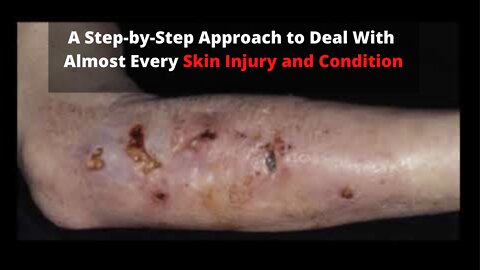 A Step-by-Step Approach to Deal With Almost Every Skin Injury and Condition