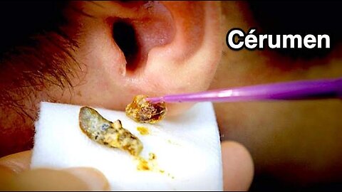 How to remove an earwax blockage? Te Natural and effective remedy