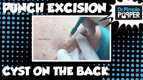 A nice little cyst punch on the back