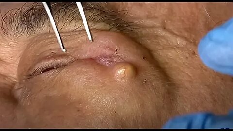 Removal of a cyst beside the eye