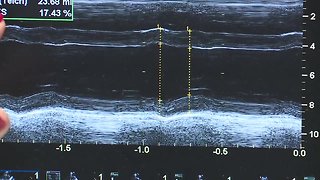 Dr. Bowlus explains echo of DCM