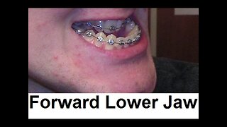 What Happens When Your Lower Jaw Grows Far Forward by Prof John Mew