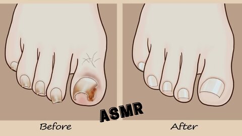 ASMR Coolness! Ingrown Toenail removal treatment animation