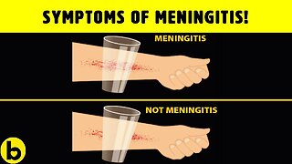 8 Meningitis Symptoms That Everyone Should Know