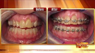 A Safe & Affordable Way to Straighten Teeth Fast