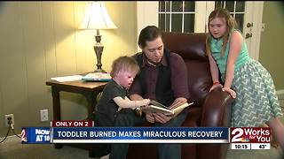 Toddler burned in house fire makes miraculous recovery