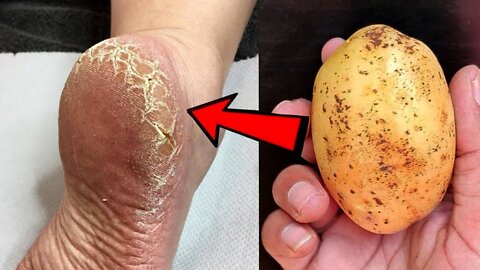 How Do You Get Rid Of Cracked Heels One Night - Home Remedy
