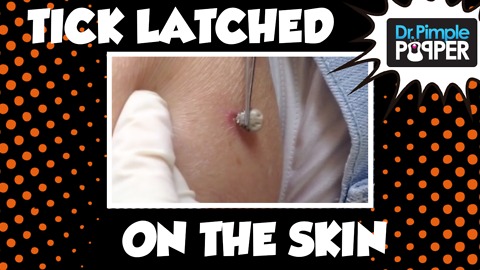 Tick Extraction from woman's side