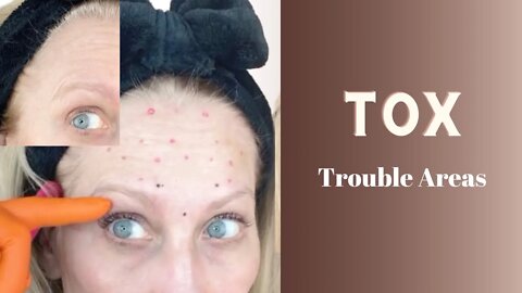 DIY Full Face Botox & How I Treat Stubborn Upper Eyebrow and Forehead Winkles