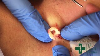 Removal of Epidermal Cyst on the Neck