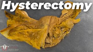 The Anatomy of a Hysterectomy