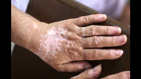 Vitiligo, High Blood Pressure, Diabetes And Sarcopenia Dr. Joel Wallach