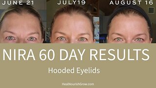 Nira Laser 60 Day Update - Hooded Eyelids