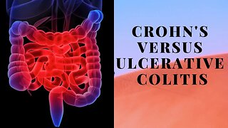 Crohn's Versus Ulcerative Colitis