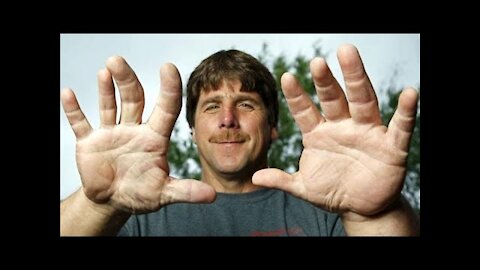 The Biggest Hands In The World |Jeff Dabe Has The World's Largest Wedding Ring Finger