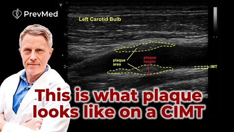 Arterial Plaque - the Butterfly CIMT screen - Dr. Craig Backs