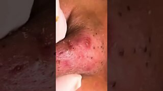 Remoção de Cravos e Espinhas - Remove Squeezing Blackheads and Pimples - Just Relax | Apenas Relaxe