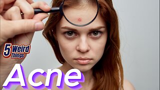 5 Weird Things - Acne (Zits!)