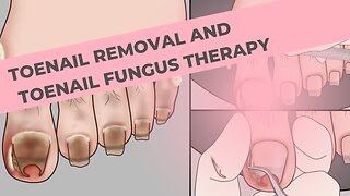 Toenail removal treatment and toenail fungus therapy