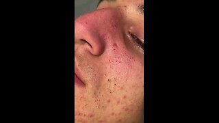 Blackheads episode 54