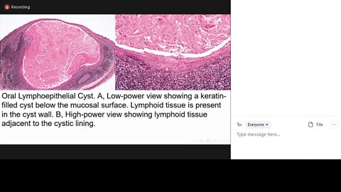 pathology L7 part2 (gingival cyst)