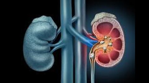 Kidney Stones | Renal Stones | Renal Calculi | Nephrolithiasis