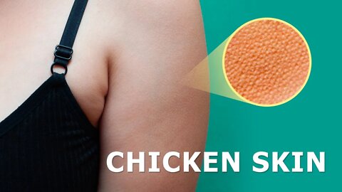 How to Heal Keratosis Pilaris (Chicken Skin) Naturally