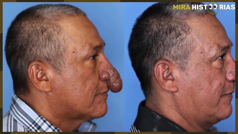 Pintor que parecia ter uma ‘genitália’ no rosto recebeu uma cirurgia de presente e voltou a sorrir
