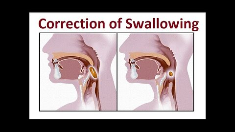 Correction & Training of Proper Swallowing Methods with Hoffman Wire by Prof John Mew