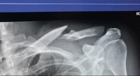 Collarbone Break (2020 yz250fx)