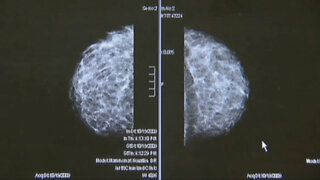Doctors, advocates praise lowering recommended age of mammograms to age 40